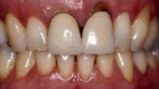 Cosmetic Dental Surgery Beautiful results from Belgium [upl. by Faith]