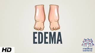 Edema Causes Signs and Symptoms Diagnosis and Treatment [upl. by Jacintha869]