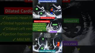 Dilated heart echocardiography l DCMP echo l हार्ट फेलियर इको l shorts [upl. by Lydell23]