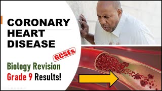 Coronary Heart Disease  GCSE Biology Exam Revision  Updated [upl. by Minnnie792]