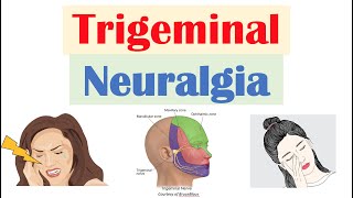 Trigeminal Neuralgia “Severe Facial Pain” Causes Pathophysiology Symptoms Diagnosis Treatment [upl. by Melc]