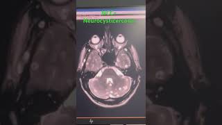 NCC NeurocysticercosisMRI Brain [upl. by Alohs]