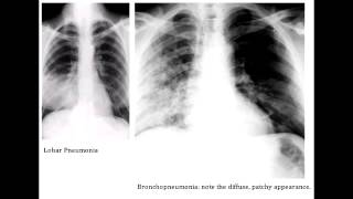 Lobar Pneumonia amp Bronchopneumonia  Organisms amp Characteristics [upl. by Weide411]