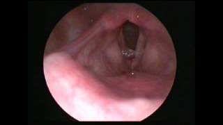 Vocal cord polyp Satyam Ent Care Centre Gwalior Dr Ravindra Bansal [upl. by Yoccm952]