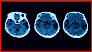 Atrophie corticale postérieure  diagnostic et traitement [upl. by Brandise864]