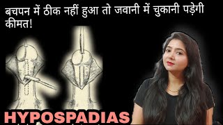 HYPOSPADIAS  बचपन में ठीक नहीं हुआ तो जवानी में चुकानी पड़ेगी कीमत [upl. by Deedee284]