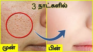 முகத்தில் உள்ள சிறுசிறு குழிகள் OPEN PORES மறைய  Open Large Pores on Face [upl. by Elvira]