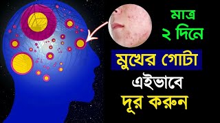 মাত্র ২ দিনে মুখের ব্রণ দূর করার টিপস  How to Remove Your Facial Pimples Without Investing Money [upl. by Oinotnaesoj616]