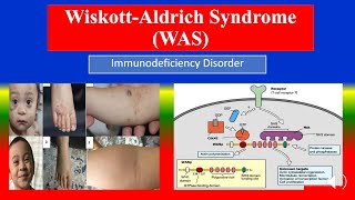 WISKOTT  ALDRICH SYNDROME WAS  Definition types cusses pathophysiology symptom medicine [upl. by Artenahs]