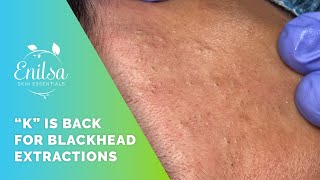 K Is Back for Blackhead Extractions [upl. by Sardse]