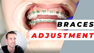 Orthodontist Explains Monthly Adjustments  Monthly Visits [upl. by Eimot]