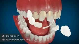 Cosmetic Dentistry Procedures  Dental Animation [upl. by Eimyaj]