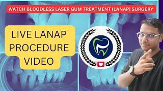 Dr Rudra Mohan  Laser Assisted New Attachment Procedure LANAP Video along with Root Planing [upl. by Auhsoj881]