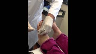 5th Metatarsal Pin Removal [upl. by Aimar]