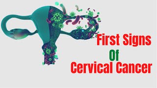 Signs Of Cervical Cancer Stage 1  Symptoms For Cervical Cancer [upl. by Flora]