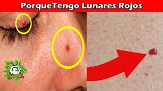 Porque Tengo Lunares Rojos En La Piel a Qué Se Deben y Como Poder Quitarlos Con Este Genial Remedio [upl. by Eglanteen415]