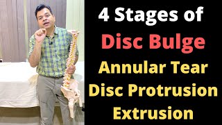 Stages of Disc Bulge Annular Tear Disc Protrusion Disc Extrusion Herniated Disc Stages [upl. by Newob801]