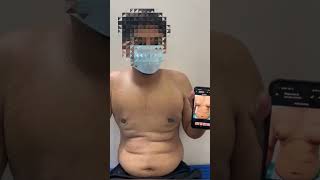 Gynecomastia Grade 2 Patient Feedback After 3 Days  Dr Deepesh Goyal  Rejuvena Cosmo Care Jaipur [upl. by Ayotl]