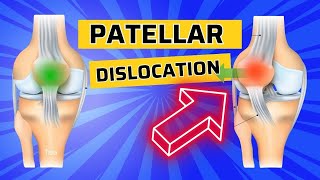 Top 3 Exercises after Patellar Dislocation How to Strengthen the VMO [upl. by Jorrie]