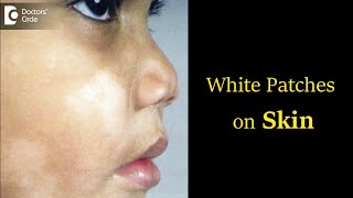 White Patches on Skin What can it be Diagnosis Causes Symptoms Dr Rasya Dixit Doctors Circle [upl. by Liemaj721]