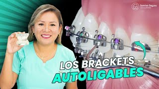 ¡Revolución en Ortodoncia Descubre Cómo los Brackets Autoligantes Cambian el Juego de la Sonrisa [upl. by Yeltneb]