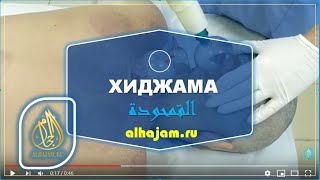 Точки хиджамы Точка Комхуда حجامة الرأس القمحودة [upl. by Alleuqcaj620]