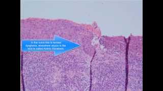 Squamous Cell Carcinoma [upl. by Geddes]