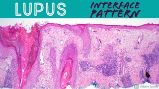 Lupus Erythematosus  Interface Dermatitis Inflammatory Dermpath Basics for Dermatology amp Pathology [upl. by Perusse]