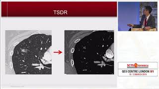 Treatment Strategy for Ground Glass Opacity and Tiny Lung Nodules [upl. by Acihsay7]