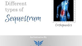 Types of Sequestrum in less than 3 mins [upl. by Olaf]