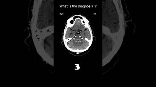 Tentorium cerebelli  CT brainaxial image CT Brain Anatomy Meninges Quiz 11radiologychannel007 [upl. by Aneetak]