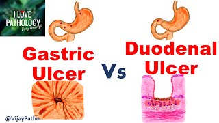 Peptic Ulcer Disease GASTRIC VS DUODENAL ULCERS [upl. by Cheng559]