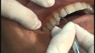 Periodontal Abscess [upl. by Warfield]