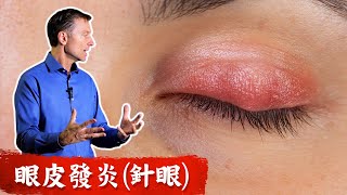 眼皮發炎針眼的自然療法柏格醫生 dr berg [upl. by Natiha]