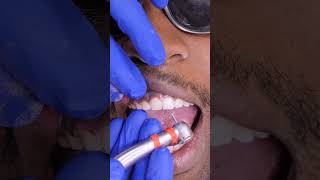 How Tooth Shaving Works [upl. by Sible]