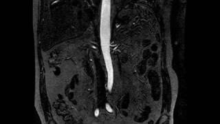 AORTA ABDOMINAL Arterial [upl. by Haberman]