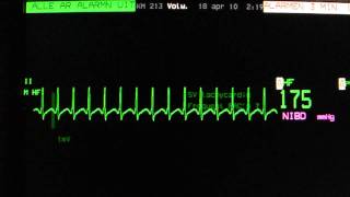 AV nodal reentry tachycardia AVNRT on an ECG heart monitor [upl. by Eira]