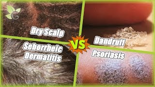 Dry Scalp vs Dandruff vs Seborrheic Dermatitis vs Psoriasis [upl. by Market]