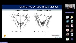 Indications Neurogenic Claudication amp Lateral Recess Stenosis  Phil Fagan MD [upl. by Swanhildas776]