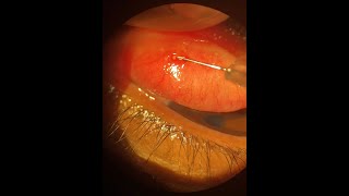 Management of Conjunctival Concretions [upl. by Ahcsat679]