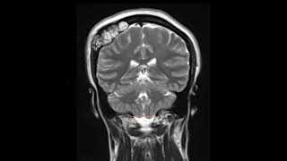 Intraosseous hemangioma of calvarium [upl. by Palla]