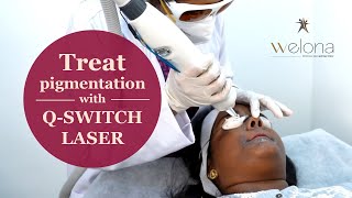 Skin Whitening ❌ Skin Lightening ✅  Qswitch Laser Treatment in Chennai [upl. by Leonardo]