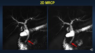 CholedocholithiasisMRCP diagnosis and pitfalls [upl. by Enenaej]