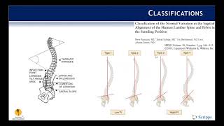 Classification Adult Spinal Deformity [upl. by Leahcimnhoj]