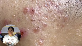 Acne Treatment Huong Da Nang The video has been lost for a long time Remove Blackheads [upl. by Gnuhn]