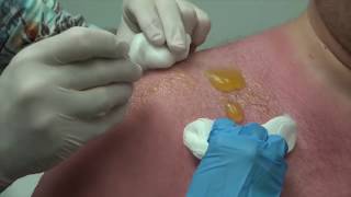 Popping Big Sun Burn Blisters with Dr G [upl. by Muna]