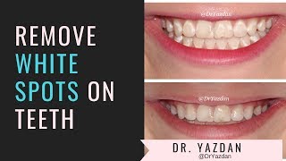 How To Remove White Spots On Teeth  Icon Dental Treatment  Dr Yazdan [upl. by Binnings]