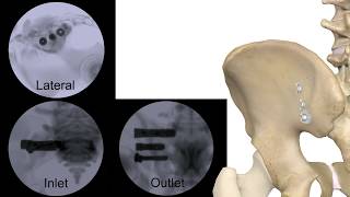 Corelink Entasis Sacroiliac Joint Fusion [upl. by Archibald]