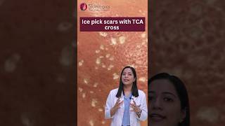 Ice Pick Scars Treatment  Ice Pick Scars TCA Cross  Acne Scar Treatment in Noida  Skinlogics [upl. by Eerdua]