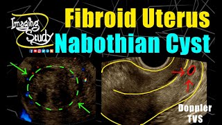 Fibroid Uterus with Nabothian Cyst  TVS  Doppler  Ultrasound  Case 249 [upl. by Ellenahs]